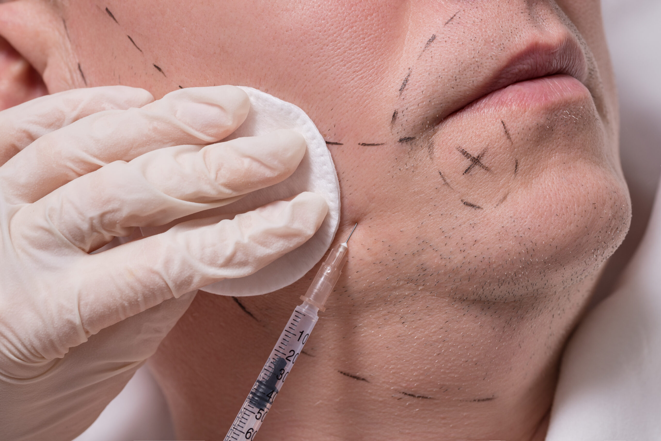 Man beauty procedure beard hair implant for senior man