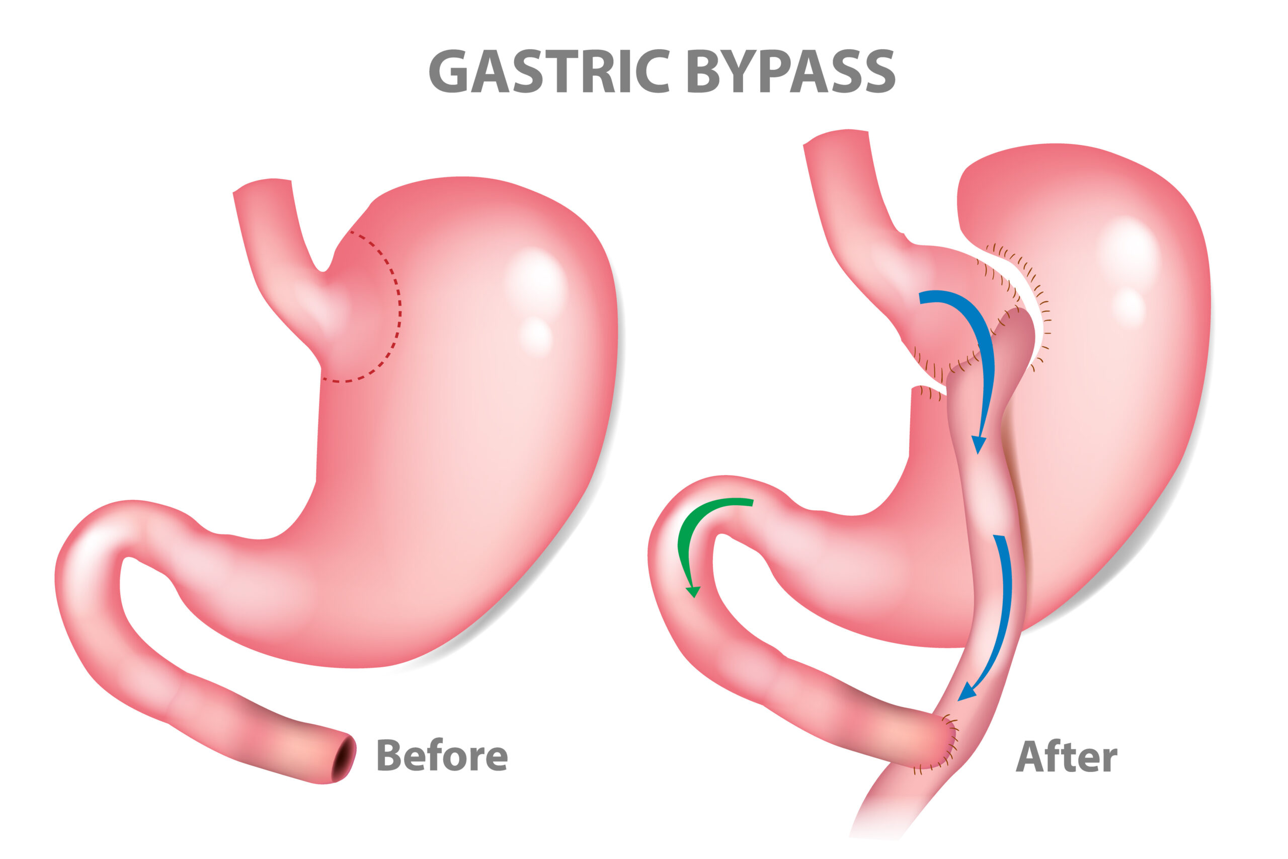 Gastric bypass surgery – RNY (Roux-en-Y ). MINI-GASTRIC BYPASS