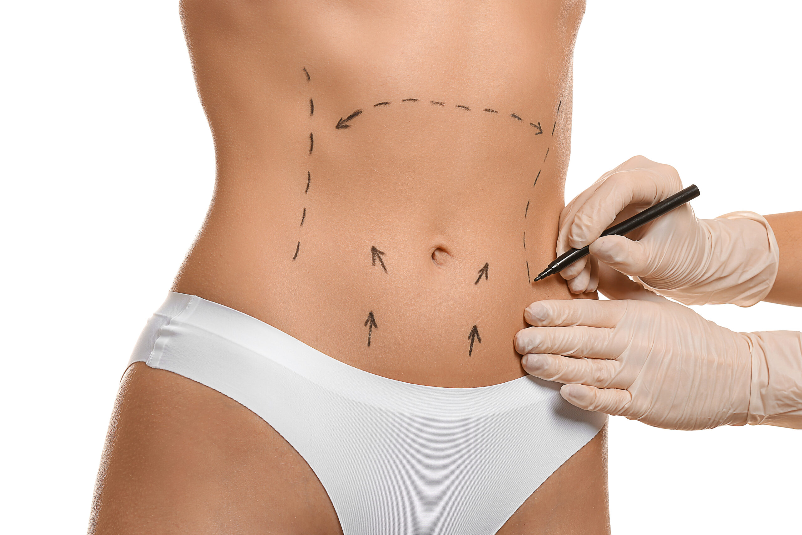 Plastic surgeon applying marks on female body against white background